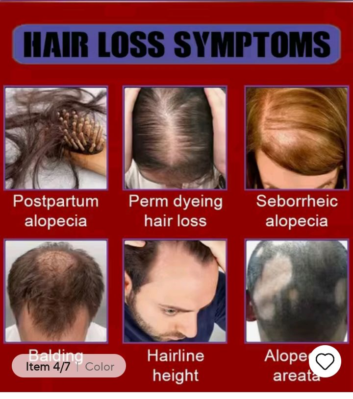 Hair loss treatment Ac63427377243139122
